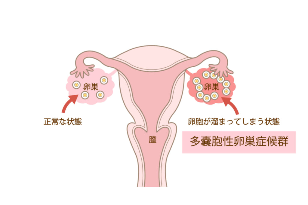 多囊胞性卵巣症候群